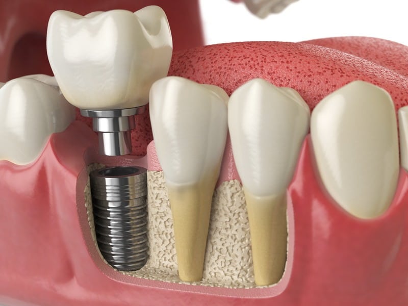 Implantaten onderhouden en | Dental4all